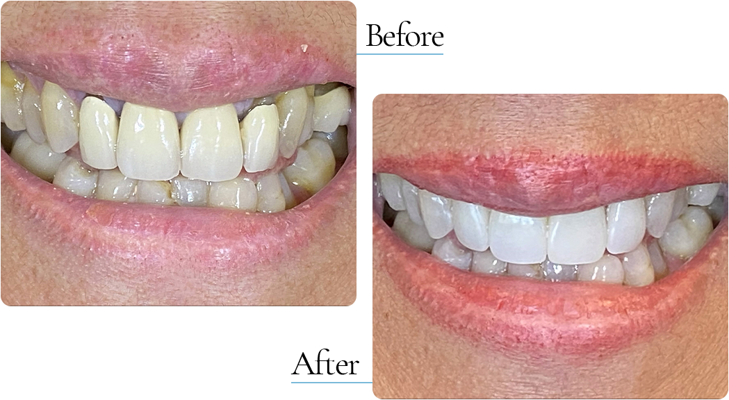 Whitening and Porcelain Crowns
